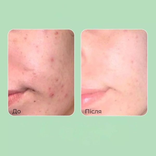 Пінка для обличчя з чайним деревом Medi-Peel Dutch Tea Bubble Cleanser 160 мл 490-365 фото
